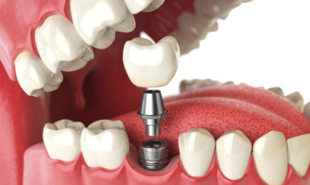 Dental implants restorative dentistry