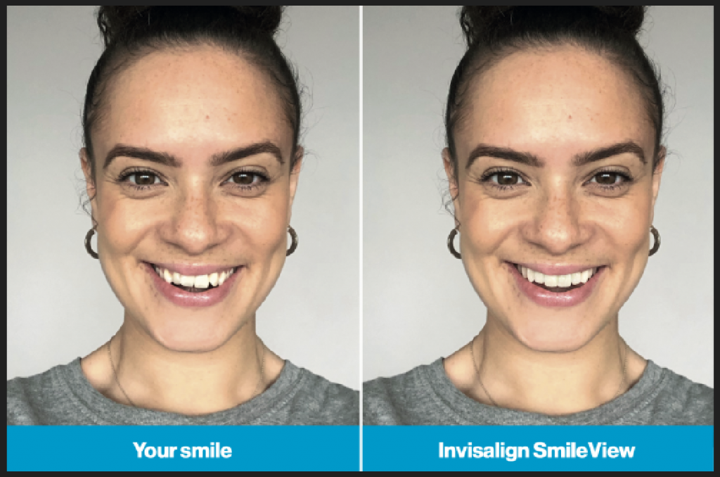 Invisalign Before and After example from SmileView Tool
