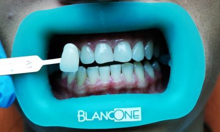 Final results of BlancOne Click treatment (3 to 4 shades whiter with no sensitivity, affordable and quick.