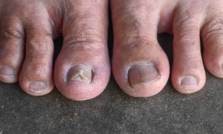 Ageing feet can be treated by our Podiatrsit
