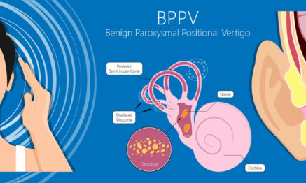 bppv condition