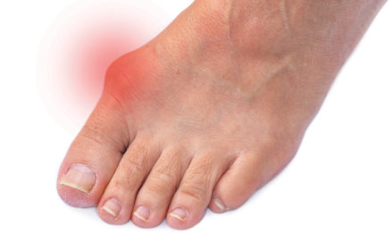 Bunion (or Arthritis) can be treated by our Podiatrsit