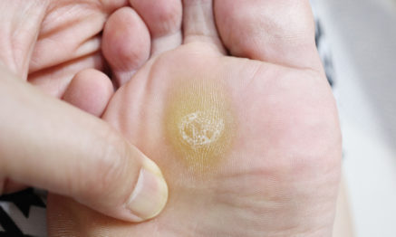 callus and corns condition can be treated by our podiatrist
