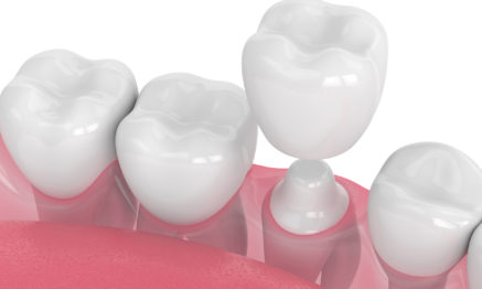 Dental Crowns restorative dentistry