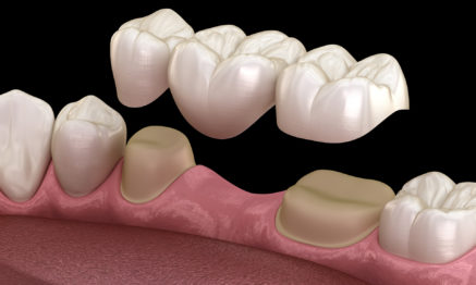 Dental Bridge treatment restorative dentistry