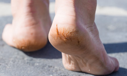 dry cracked heels condition can be treated by our Podiatrist