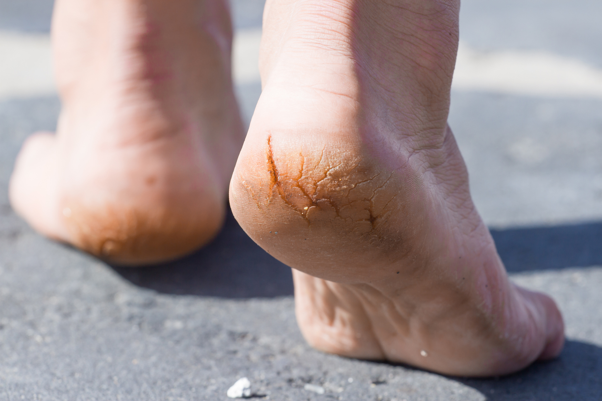 Podiatry First Bondi Junction - Dry cracked heels are a common foot dilemma  that can often lead to tenderness and become a source of discomfit. If left  untreated, the cracks will develop