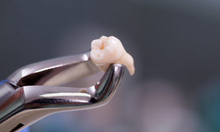 Extractions of teeth as last resort in dental treatments