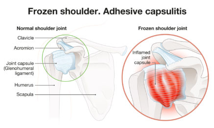 frozen shoulder condition