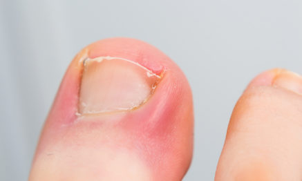 Ingrowing toenails can be treated by our Podiatrsit