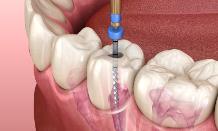 Root Canal treatment with instrument