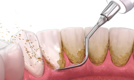Hygienist doing scaling and root planning