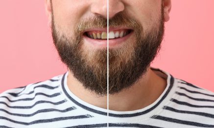 Smile makeover before and after picture