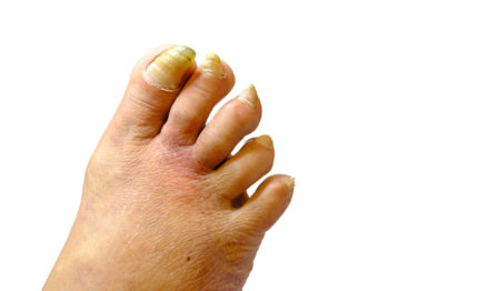 thick or painful nails can be treated by our Podiatrsit