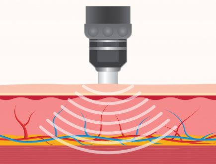 Shockwave Therapy Milton Keynes