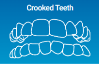 Crooked Teeth can be solved by Invisalign Clear Aligners