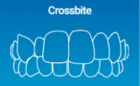 Cross bite can be solved by Invisalign Clear Aligners