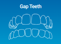 Gaps in Teeth can be reduced by Invisalign Clear Aligners