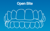 Open Bite can be solved by Invisalign Clear Aligners
