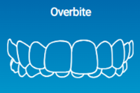 Overbite can be solved by Invisalign Clear Aligners
