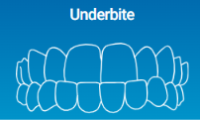 Under bit can be solved by Invisalign Clear Aligners